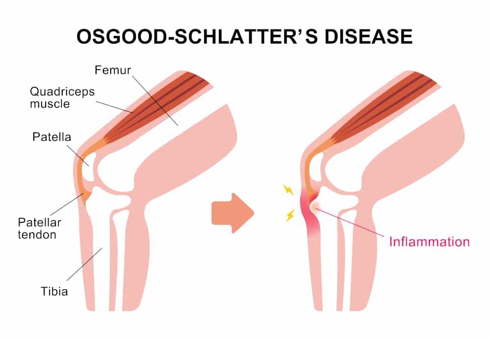 Sindrome di Osgood Schlatter