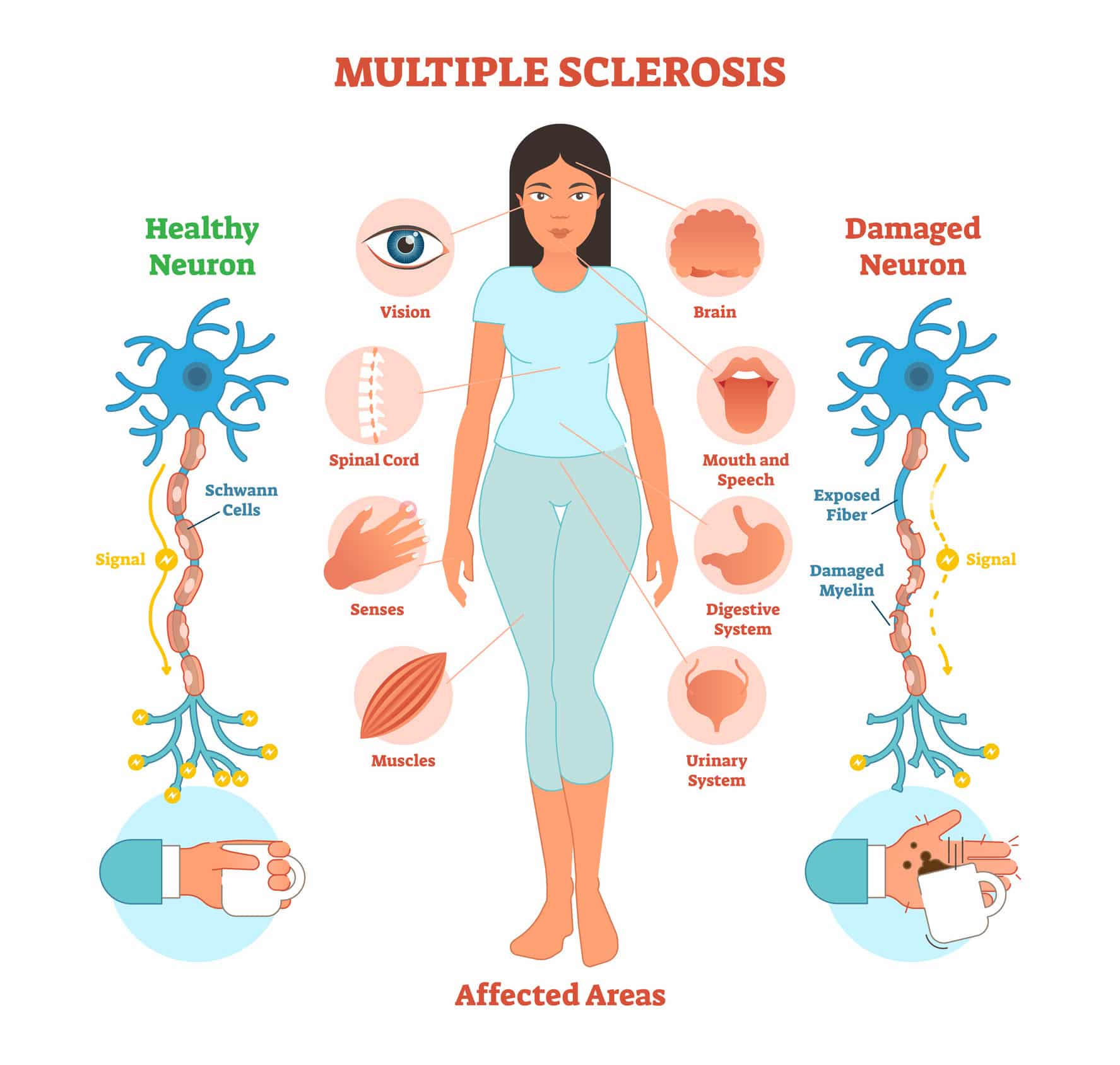 Sclerosi Multipla