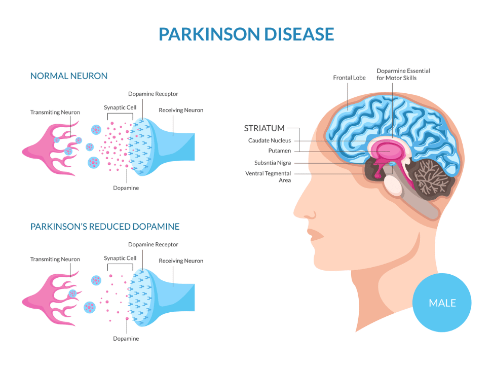 Morbo di Parkinson
