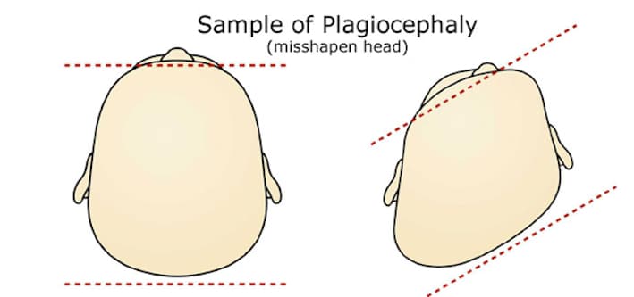 plagiocefalia