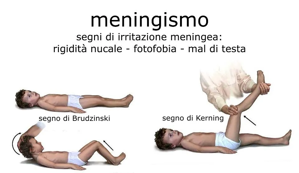 Meningite - segno di Kernig - segno di Brudzinski