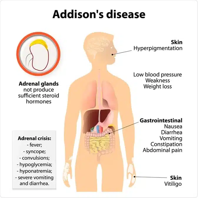 Malattia di Addison