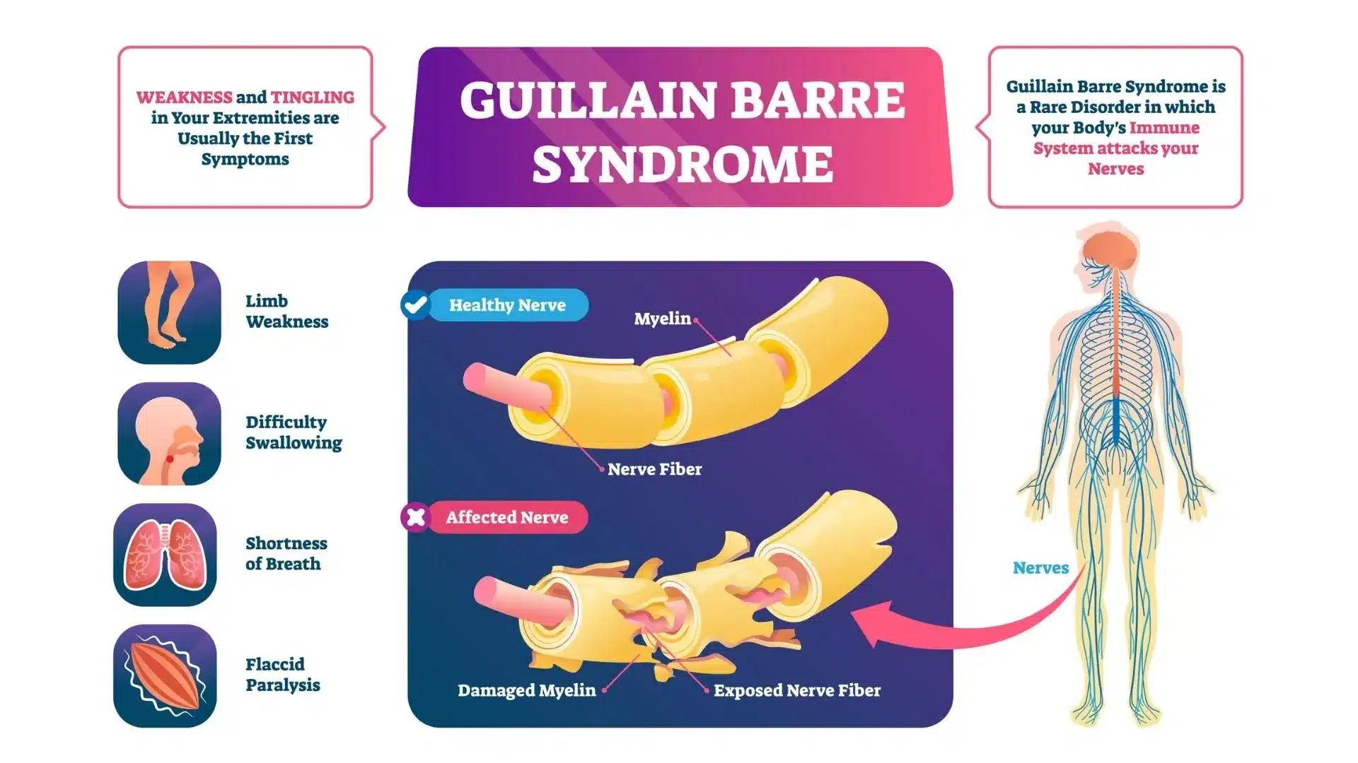 Sindrome di Guillain-Barré 